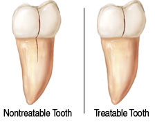 Cracked Tooth Treatment in Irvine & Riverside