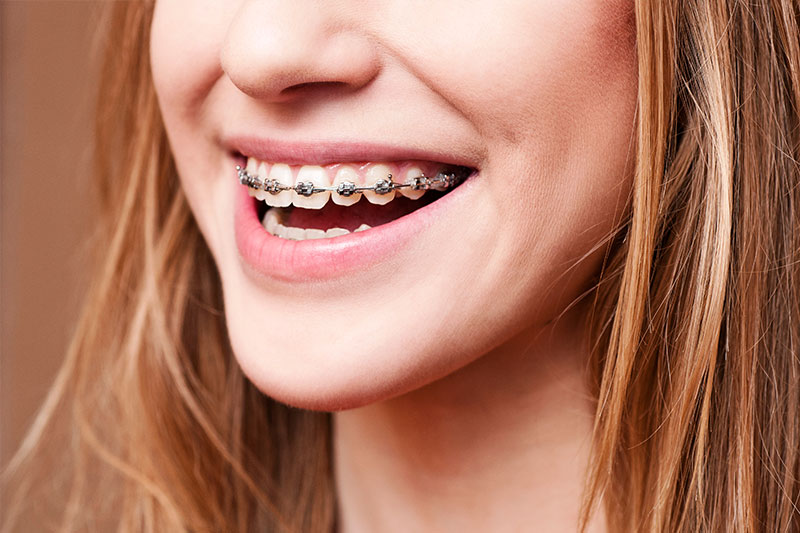 Orthodontics in Irvine and Riverside
