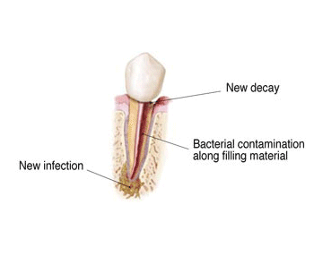 Root Canal Retreatment in Irvine & Riverside