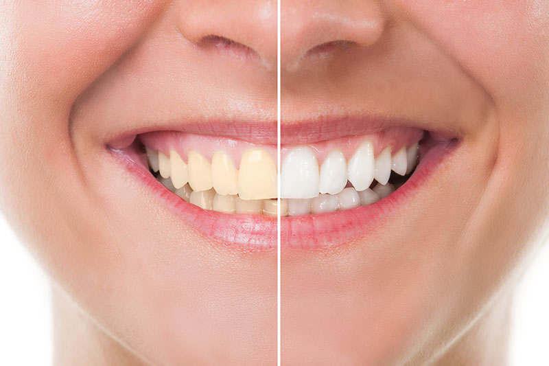 Teeth Whitening in Irvine and Riverside